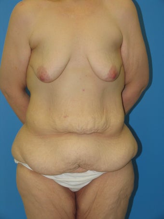 40 yr old woman for body lift before 1038468