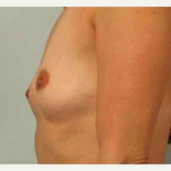 35-44 year old woman treated with Breast Augmentation before 3261177