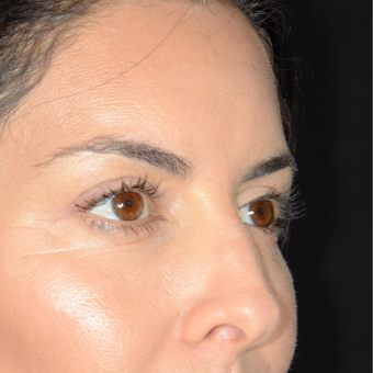 35-44 year old woman treated with Eyelid Surgery after 3099358
