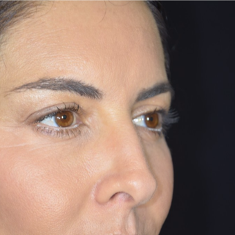35-44 year old woman treated with Eyelid Surgery before 3099358