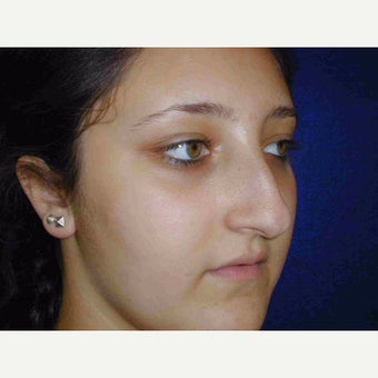 17 or under year old woman treated with Rhinoplasty before 1735580
