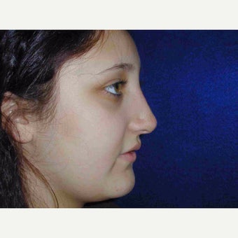 17 or under year old woman treated with Rhinoplasty 1735580