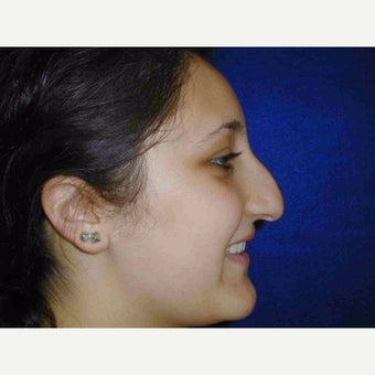 17 or under year old woman treated with Rhinoplasty 1735580