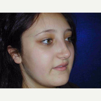 17 or under year old woman treated with Rhinoplasty after 1735580