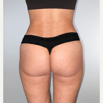25-34 year old woman treated with Brazilian Butt Lift after 3104478