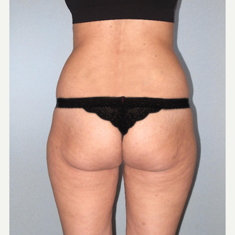 25-34 year old woman treated with Brazilian Butt Lift before 3104478