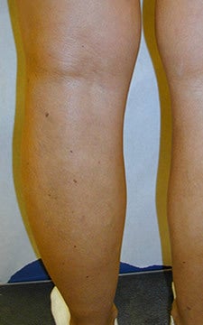 Patient treated for blue bulging varicose veins of the legs after 914981