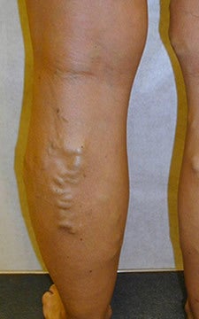 Patient treated for blue bulging varicose veins of the legs before 914981