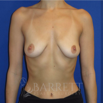25-34 year old woman treated with Breast Implants before 3605840