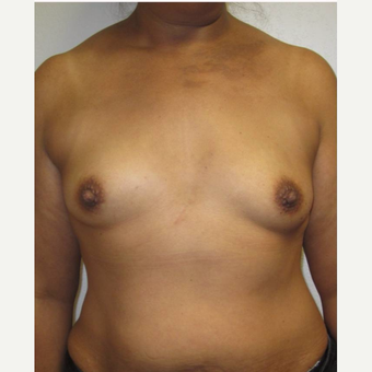 35-44 year old woman treated with Breast Reconstruction before 3502612