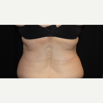 55-64 year old woman treated with CoolSculpting after 3366359