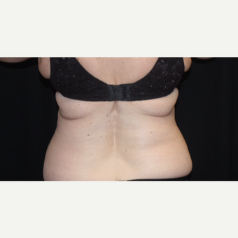 55-64 year old woman treated with CoolSculpting before 3366359