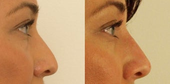 Female Non-surgical rhinoplasty before 1181361