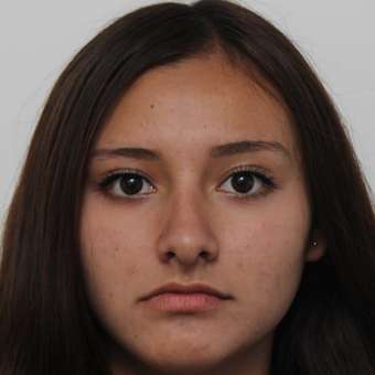 17 or under year old woman treated with Rhinoplasty before 3418799