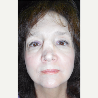 55-64 year old female with Revision Rhinoplasty before 3187217