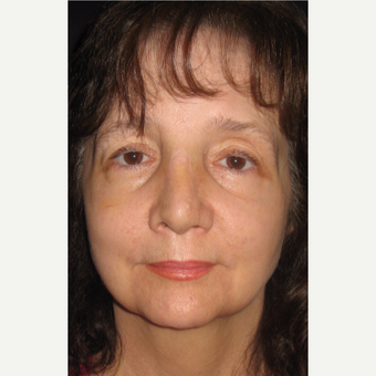 55-64 year old female with Revision Rhinoplasty after 3187217