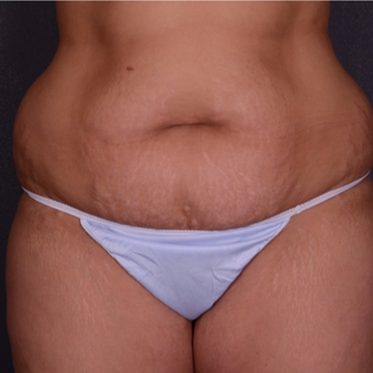 35-44 year old woman treated with Tummy Tuck before 3738179