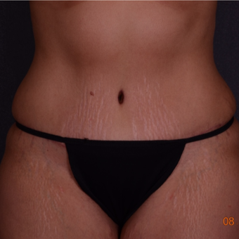 35-44 year old woman treated with Tummy Tuck after 3738179