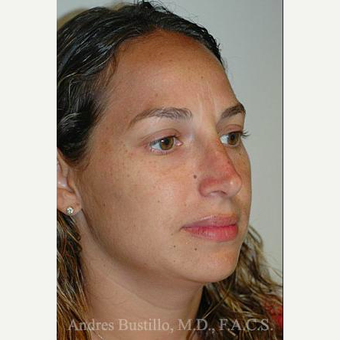 35 year old woman treated with Rhinoplasty after 3461039