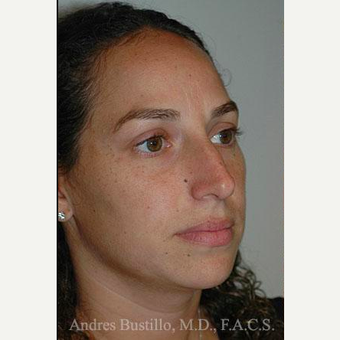 35 year old woman treated with Rhinoplasty before 3461039