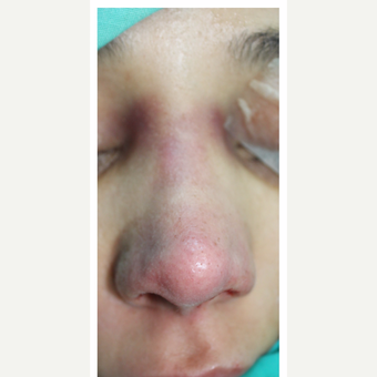 25-34 year old woman treated with Rhinoplasty after 3390041