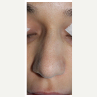 25-34 year old woman treated with Rhinoplasty before 3390041