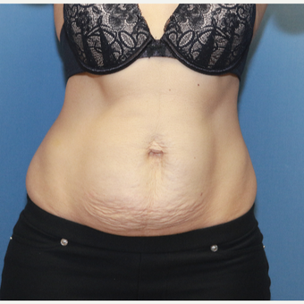 35-44 year old woman treated with Tummy Tuck before 3524573