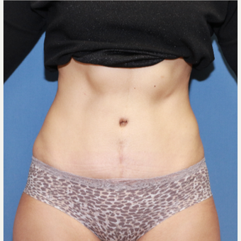 35-44 year old woman treated with Tummy Tuck after 3524573