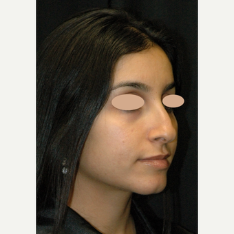 25-34 year old woman treated with Rhinoplasty before 3783145