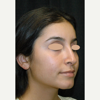 25-34 year old woman treated with Rhinoplasty after 3783145