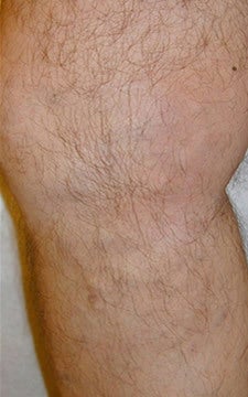 Varicose Vein Treatment Legs after 914971