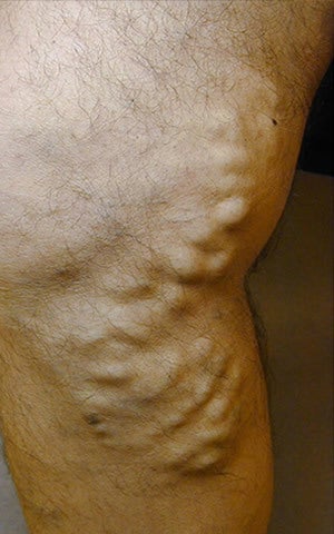 Varicose Vein Treatment Legs before 914971