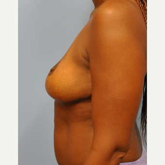 44 year old woman who had a breast reduction. 500g, from H cup to C cup. after 3304129