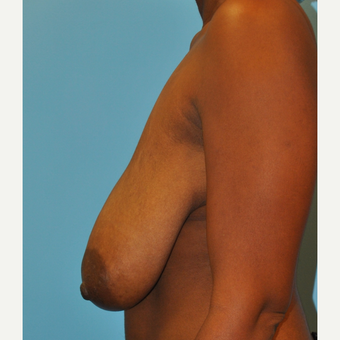 44 year old woman who had a breast reduction. 500g, from H cup to C cup. before 3304129