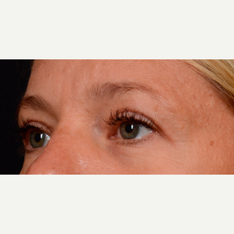 35-44 year old woman treated with Eyelid Surgery after 3776241