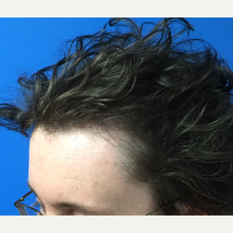 25-34 year old man treated with Hair Transplant after 3453520