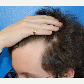 25-34 year old man treated with Hair Transplant before 3453520