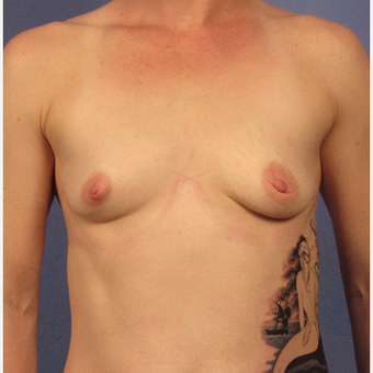 25-34 year old woman treated with Breast Augmentation before 3321901
