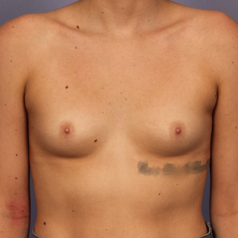18-24 year old woman treated with Breast Augmentation before 3494784