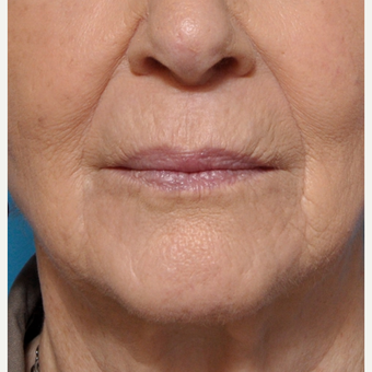 Treating Fine Lines Around the Mouth after 3793627