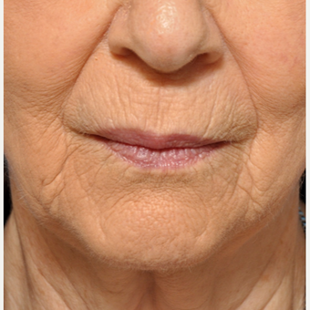 Treating Fine Lines Around the Mouth before 3793627