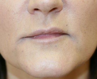 Juvederm into downturned corners of mouth after 845638