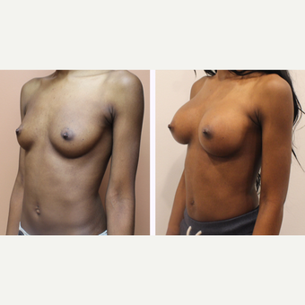 35-44 year old woman treated with Breast Augmentation before 3300105