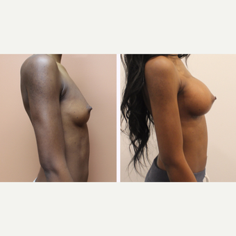 35-44 year old woman treated with Breast Augmentation after 3300105