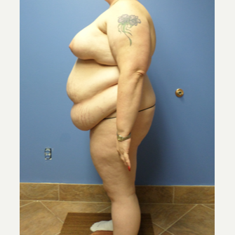 35-44 year old woman treated with Weight Loss before 3370135