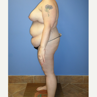35-44 year old woman treated with Weight Loss after 3370135