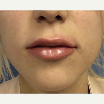18-24 year old woman treated with Lip Augmentation after 3697494