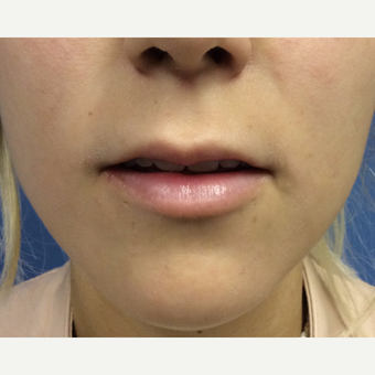 18-24 year old woman treated with Lip Augmentation before 3697494
