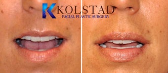 Natural Lip Augmentation after 1260559