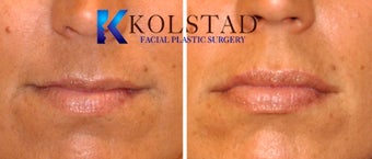 Natural Lip Augmentation before 1260559